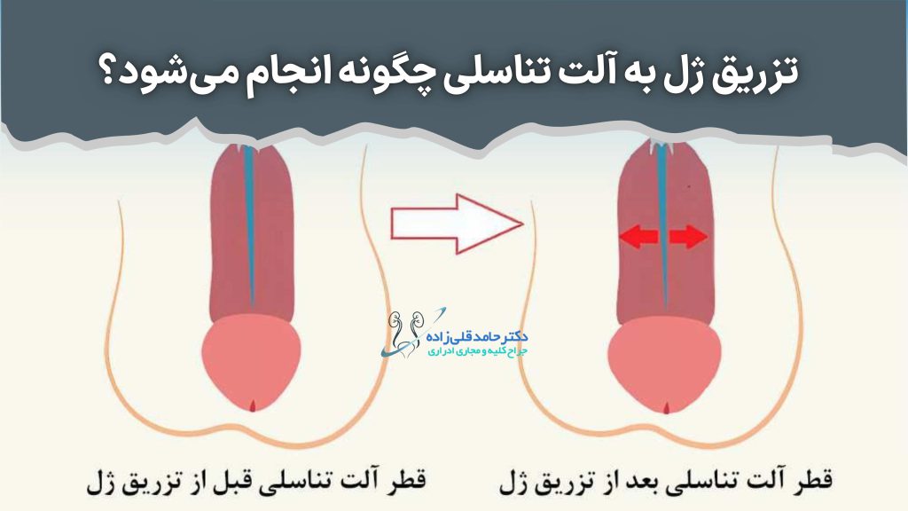 عوارض تزریق ژل به اندام تناسلی مردان+تجربه مردان از تزریق ژل به آلت